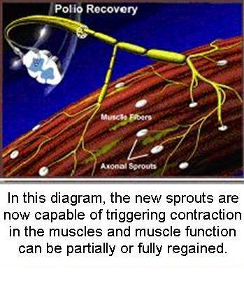 Recovery from Acute Paralytic Polio