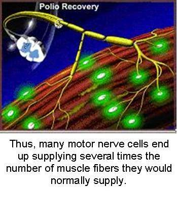 Recovery from Acute Paralytic Polio